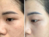 PEEL TRỊ NÁM 
