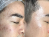 PEEL TRỊ MỤN