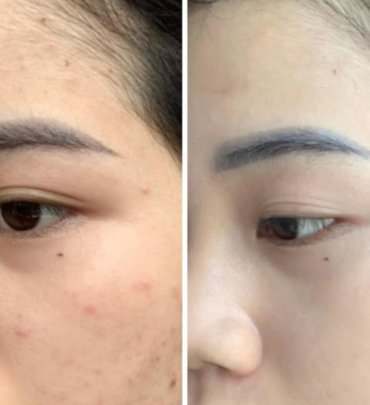 PEEL TRỊ NÁM 