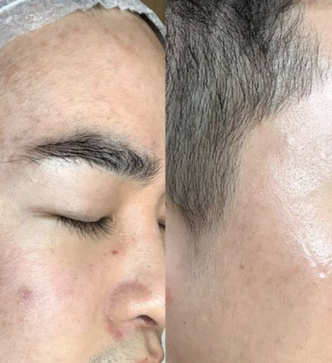PEEL TRỊ MỤN