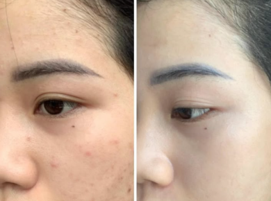PEEL TRỊ NÁM 
