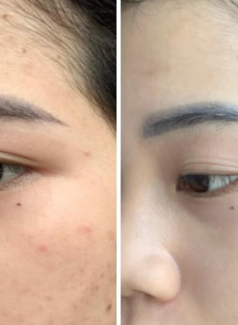 PEEL TRỊ NÁM 